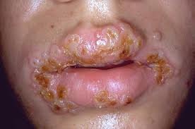 Cure Herpes Outbreak Fast : Therapy By Fever Blisters_ Klike Now What They Are